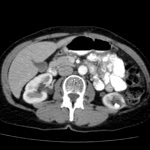 File:Atypical renal cyst (Radiopaedia 17536-17251 renal cortical phase 19).jpg