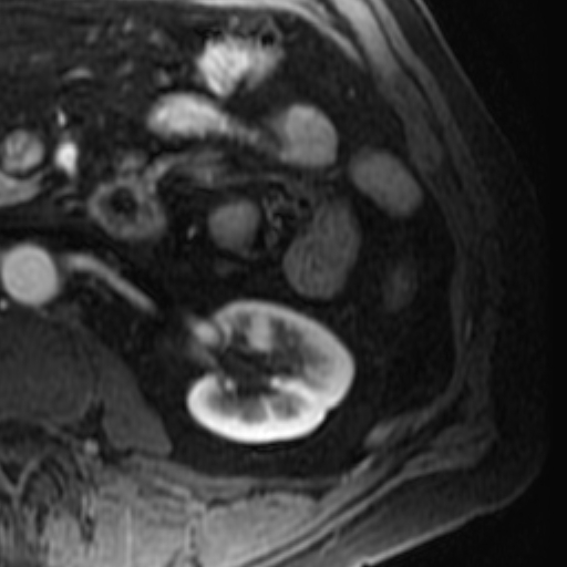 File:Atypical renal cyst on MRI (Radiopaedia 17349-17046 C 20).jpg