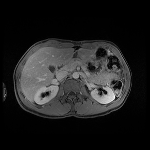 Autoimmune pancreatitis (Radiopaedia 69751-79729 N 63).jpg
