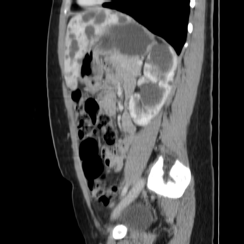 Autosomal dominant polycystic kidney disease (Radiopaedia 23061-23093 F 37).jpg