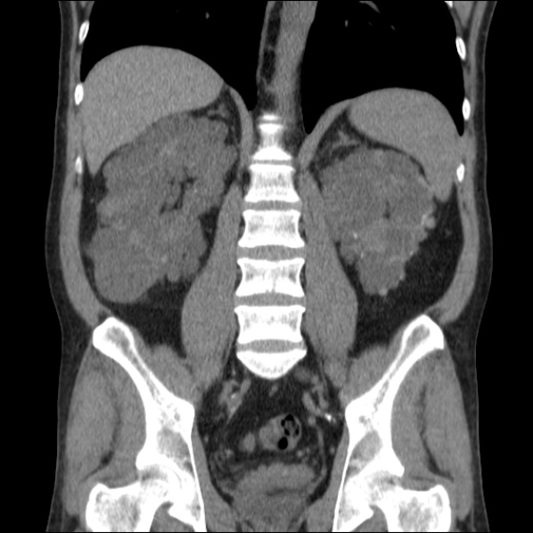 Autosomal dominant polycystic kidney disease (Radiopaedia 36539-38101 C 45).jpg