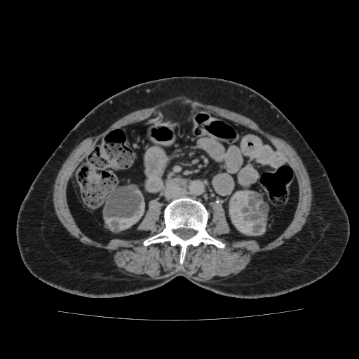Autosomal dominant polycystic kidney disease (Radiopaedia 38189-40194 Axial C+ delayed 28).jpg