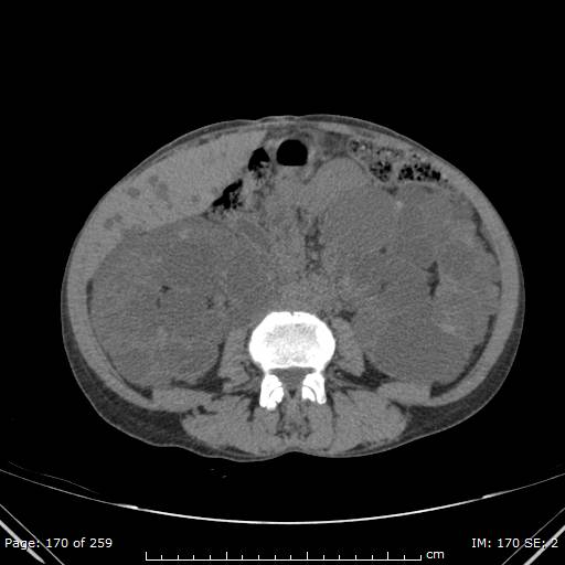 File:Autosomal dominant polycystic kidney disease (Radiopaedia 44122-47684 Axial non-contrast 61).jpg