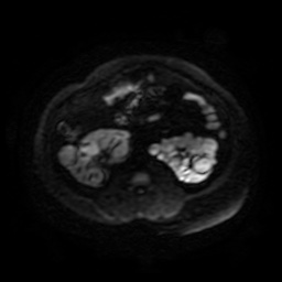 File:Autosomal dominant polycystic kidney disease (Radiopaedia 50259-55611 Axial DWI 63).jpg