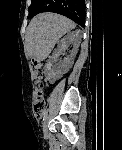 Autosomal dominant polycystic kidney disease (Radiopaedia 87830-104287 C 24).jpg