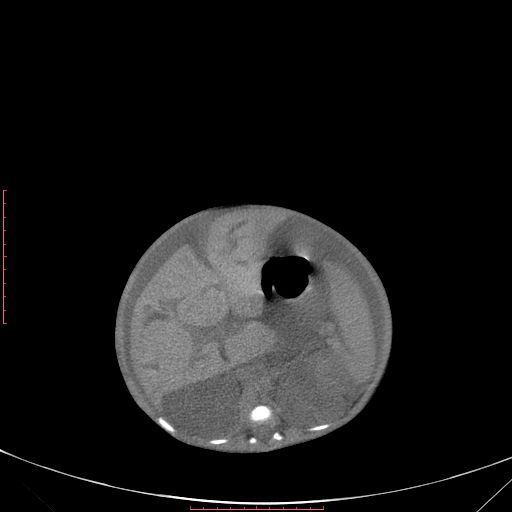 Autosomal recessive polycystic kidney disease associated with Caroli disease (Radiopaedia 61932-69984 Axial non-contrast 166).jpg