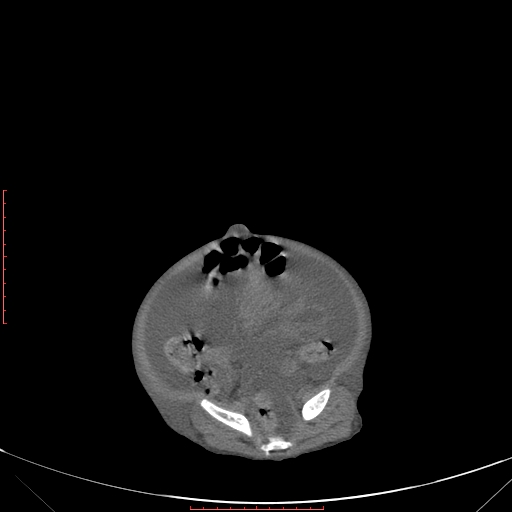 Autosomal recessive polycystic kidney disease associated with Caroli disease (Radiopaedia 61932-69984 Axial non-contrast 303).jpg
