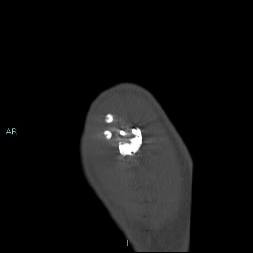 Avascular necrosis after fracture dislocations of the proximal humerus (Radiopaedia 88078-104653 Sagittal bone window 11).jpg