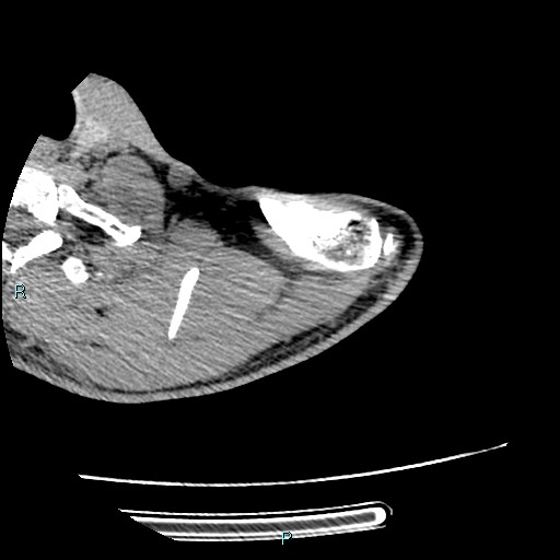 Avascular necrosis after fracture dislocations of the proximal humerus (Radiopaedia 88078-104655 D 24).jpg