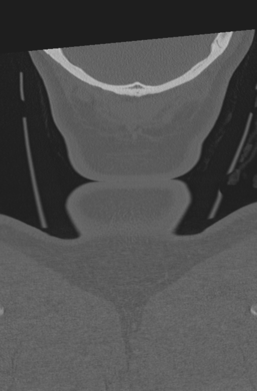 Axis peg fracture (type 3) and atlas lateral mass (type 4) fracture (Radiopaedia 37474-39324 Coronal bone window 73).png