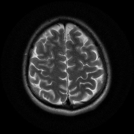 File:Azygos anterior cerebral artery (Radiopaedia 17059-16756 Axial T2 5).jpg