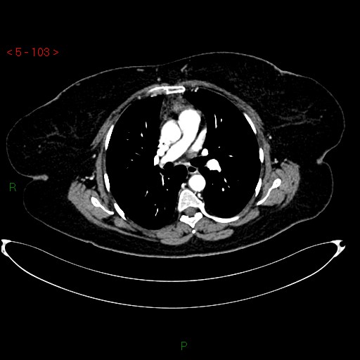 Azygos fissure and lobe (Radiopaedia 47620-52278 A 89).jpg