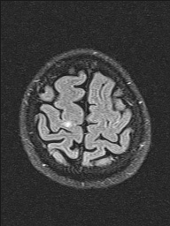 File:Balo concentric sclerosis (Radiopaedia 50458-55940 Axial FLAIR 6).jpg