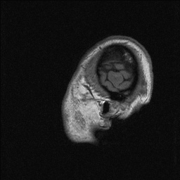 Balo concentric sclerosis (Radiopaedia 50458-55940 Sagittal T1 144).jpg