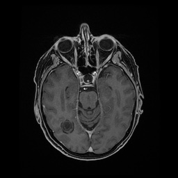 Balo concentric sclerosis (Radiopaedia 53875-59982 Axial LAVA C+ 100).jpg