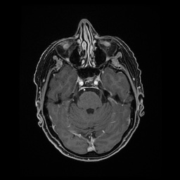 Balo concentric sclerosis (Radiopaedia 53875-59982 Axial LAVA C+ 84).jpg