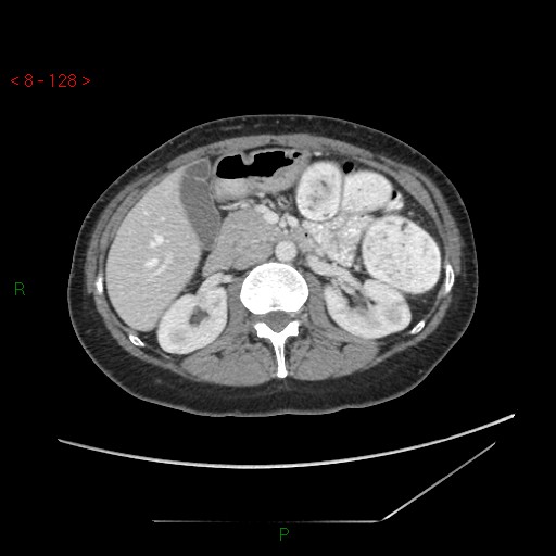 Bartholin gland cyst (Radiopaedia 54904-61181 A 32).jpg