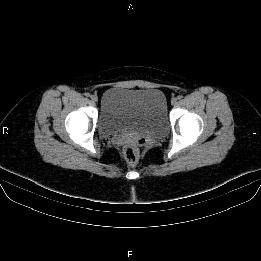 Bartholin gland cyst (Radiopaedia 62635-70930 Axial non-contrast 65).jpg