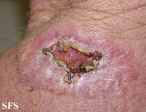 Basal Cell Carcinoma (Dermatology Atlas 69).jpg