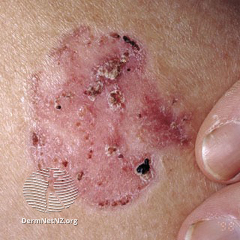 Basal cell carcinoma affecting the face (DermNet NZ lesions-bcc-face-0623).jpg