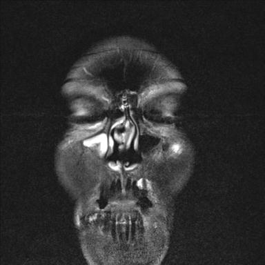 File:Base of skull chondrosarcoma (Radiopaedia 30410-31070 Coronal T2 fat sat 1).jpg