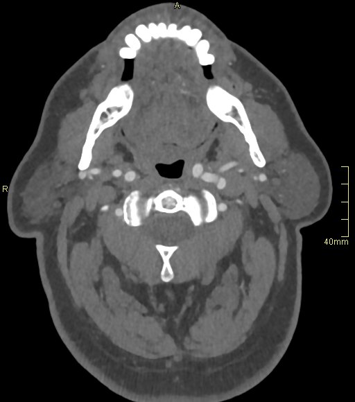 Basilar artery aneurysm (Radiopaedia 56261-62932 A 20).jpg