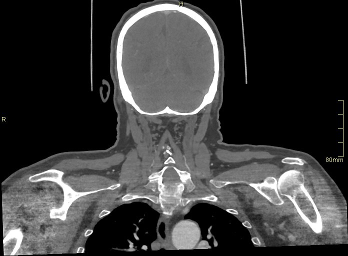 Basilar artery aneurysm (Radiopaedia 56261-62932 B 56).jpg
