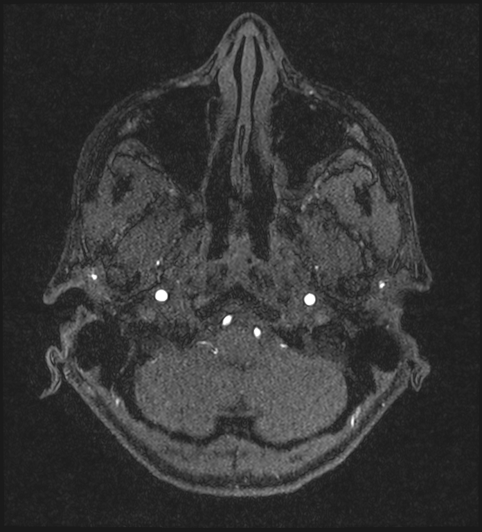 Basilar artery perforator aneurysm (Radiopaedia 82455-97733 Axial MRA 33).jpg