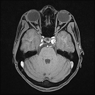 Basilar artery perforator aneurysm (Radiopaedia 82455-97733 Axial T1 fat sat 48).jpg