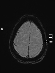 Basilar artery perforator aneurysm (Radiopaedia 82455-99523 Axial SWI 58).jpg