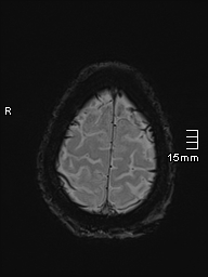 Basilar artery perforator aneurysm (Radiopaedia 82455-99523 Axial SWI 60).jpg