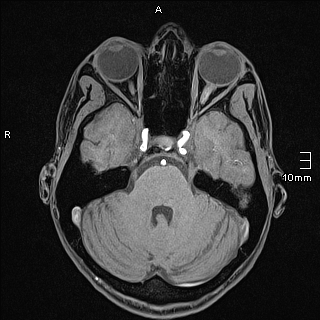 Basilar artery perforator aneurysm (Radiopaedia 82455-99523 F 37).jpg