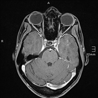 Basilar artery perforator aneurysm (Radiopaedia 82455-99523 G 43).jpg