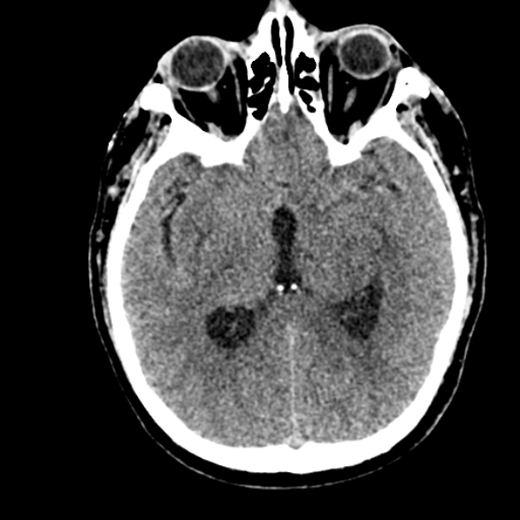 Basilar artery thrombosis (Radiopaedia 53351-59352 Axial non-contrast 59).jpg