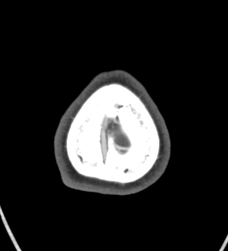 Basilar tip aneurysm with coiling (Radiopaedia 53912-60086 A 146).jpg