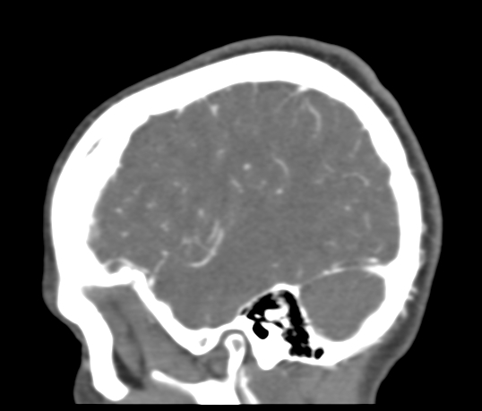 Basilar tip aneurysm with coiling (Radiopaedia 53912-60086 C 111).jpg