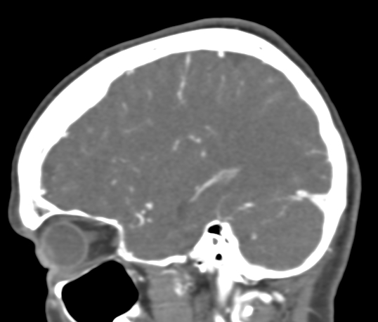 Basilar tip aneurysm with coiling (Radiopaedia 53912-60086 C 34).jpg