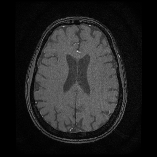 Basilar top and left middle cerebral artery aneurysm (Radiopaedia 61965-70031 Axial MRA 112).jpg