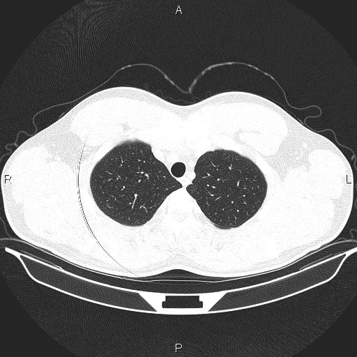 File:Beam hardening and ring artifacts (Radiopaedia 85323-100915 Axial lung window 17).jpg