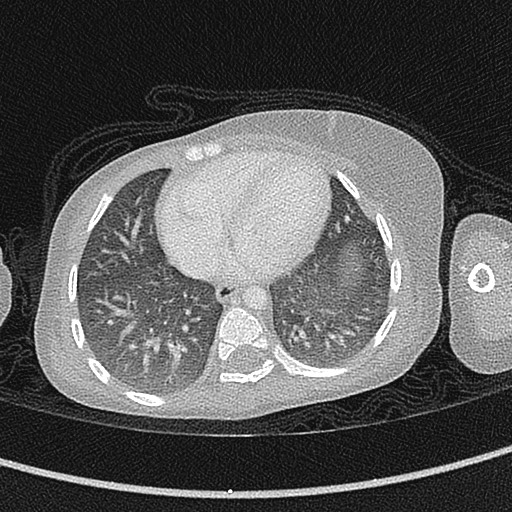 Beckwith-Wiedeman syndrome with bilateral Wilms tumors (Radiopaedia 60850-68629 Axial lung window 44).jpg