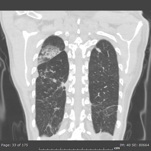 Behçet disease (Radiopaedia 44247-47889 Coronal lung window 6).jpg
