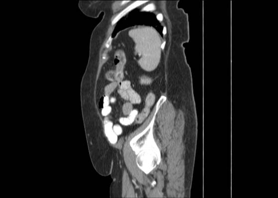 File:Bicameral celiacomesenteric aneurysm (Radiopaedia 55766-62327 B 46).jpg