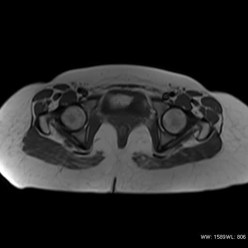 File:Bicornuate uterus- on MRI (Radiopaedia 49206-54297 Axial T1 13).jpg