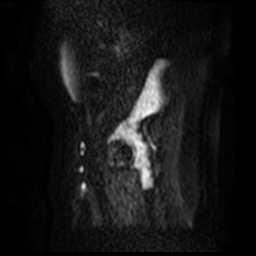 File:Bicornuate uterus (Radiopaedia 51676-57472 Sagittal DWI 50).jpg
