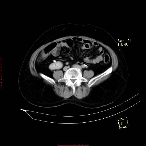File:Bifid ureter (Radiopaedia 47604-52253 Axial C+ delayed 16).jpg