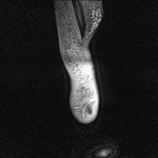 Bilateral Achilles tendon complete tear (Radiopaedia 81344-95051 Sagittal WE - Right 9).jpg