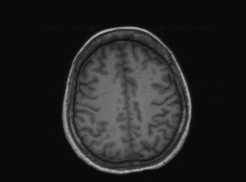 Bilateral PCA territory infarction - different ages (Radiopaedia 46200-51784 Axial T1 177).jpg