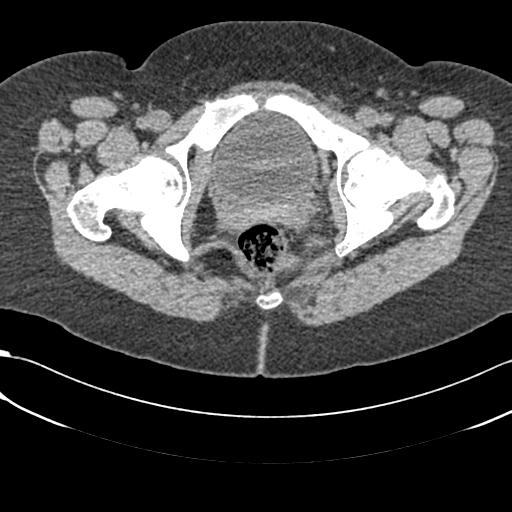 Bilateral acetabular protrusion with pincer type femoro-acetabular impingement (Radiopaedia 30134-30733 AXIAL SOFT THIN 55).jpg