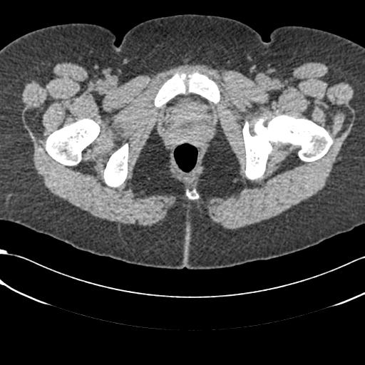 File:Bilateral acetabular protrusion with pincer type femoro-acetabular impingement (Radiopaedia 30134-30733 AXIAL SOFT THIN 71).jpg