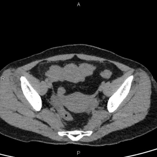Bilateral adrenal gland hyperenhancement in pancreatitis (Radiopaedia 86642-102753 Axial non-contrast 94).jpg